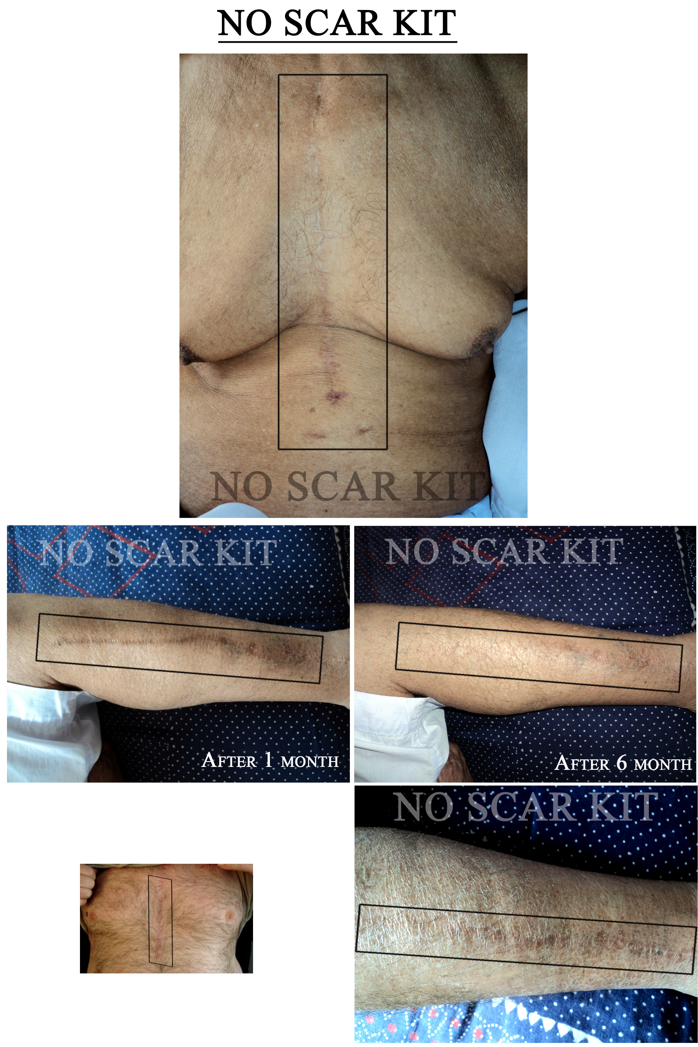 Results After Giving NO SCAR KIT